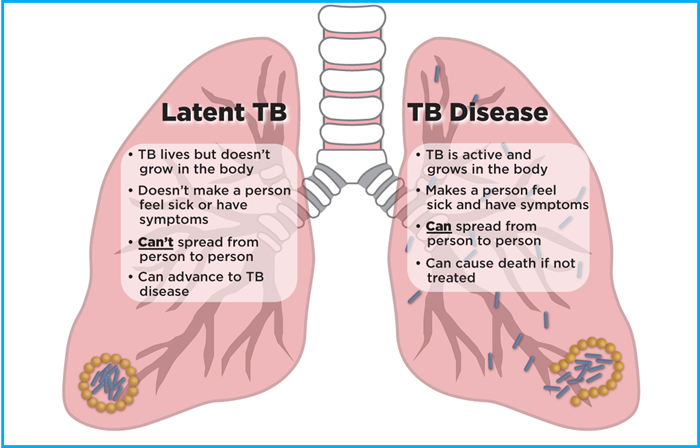 Latent TB Infection and TB Disease